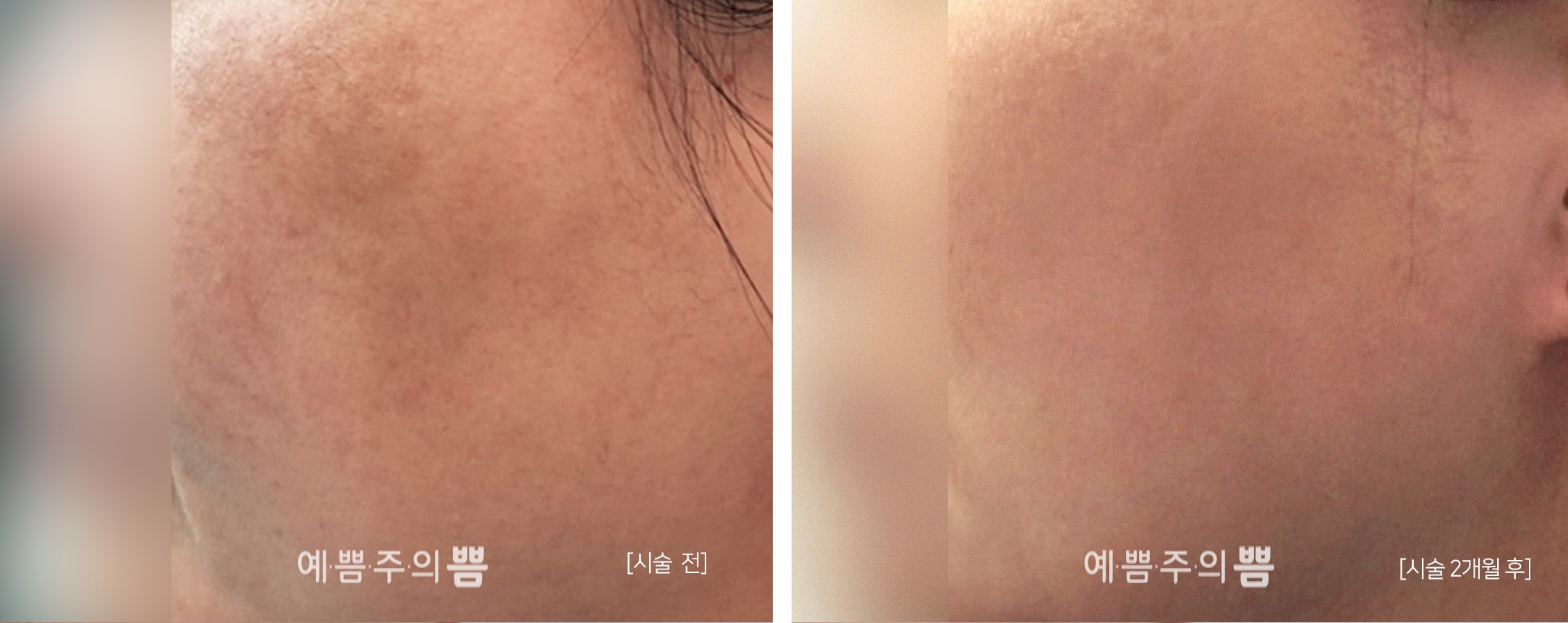 글로벌 홍대점_피코토닝