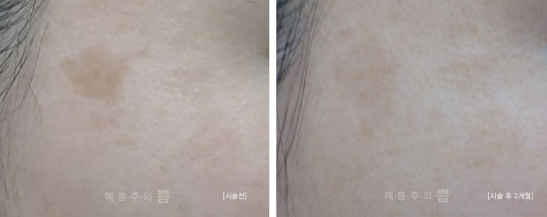 글로벌 홍대점_피코토닝