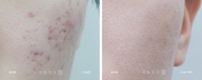 글로벌 홍대점_여드름시크릿패키지