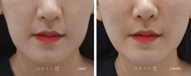 글로벌 홍대점_큐오필(옆볼,앞광대,팔자)