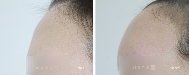 글로벌 홍대점_이마큐오필