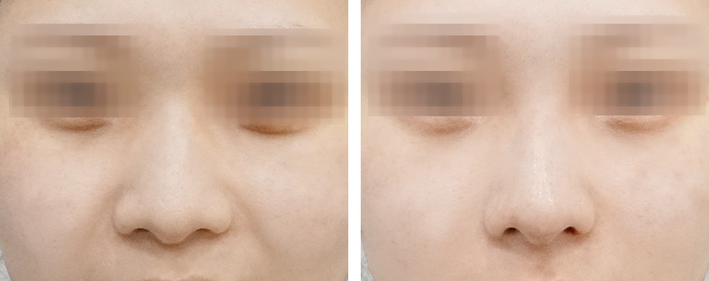글로벌 홍대점_프리미엄바비코