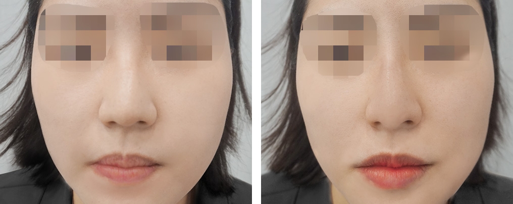 글로벌 홍대점_프리미엄바비코+입술필러
