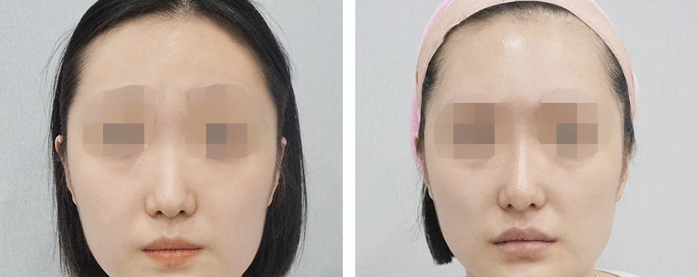 글로벌 홍대점_이마필러+바비코